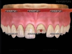 Разрушение зуба: причины, этапы процесса и профилактика