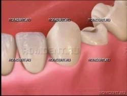 Причины разрушения зубов и как их лучше восстановить